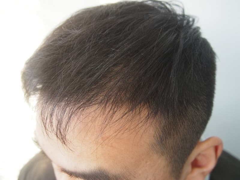같은 작성자의 수술 후 4개월 오른쪽 측면 사진