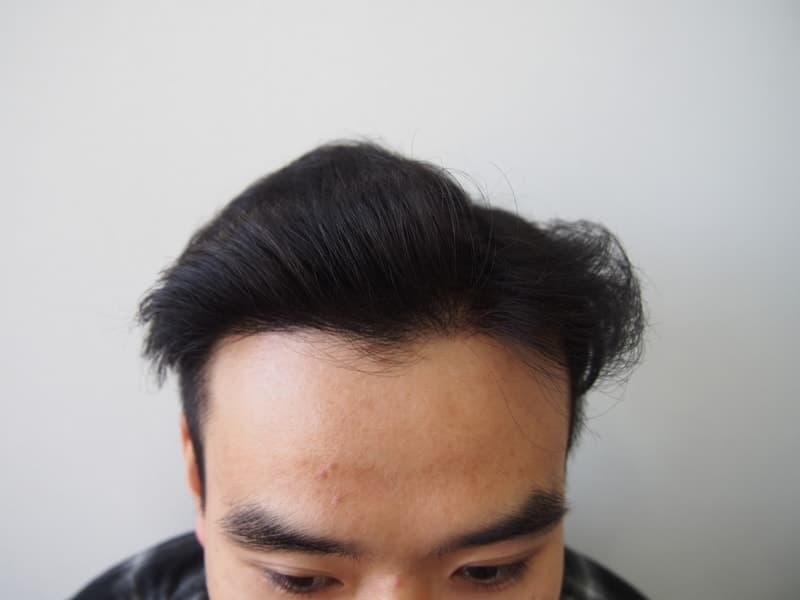 Front view 12 months after surgery from the same reviewer