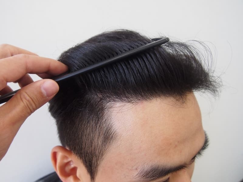 같은 작성자의 수술 후 12개월 왼쪽 측면 사진