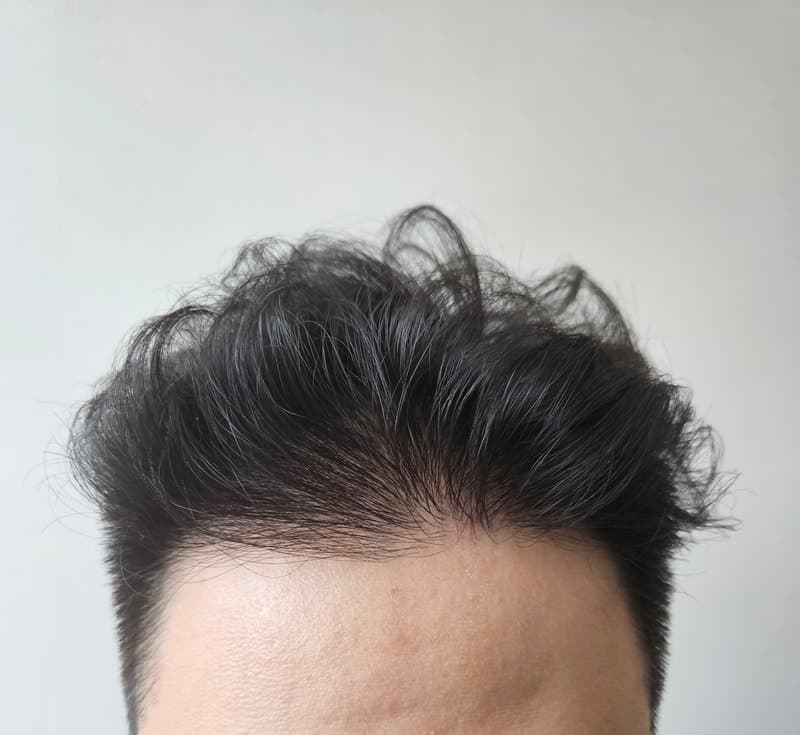作者发布的术后1年发际线照片