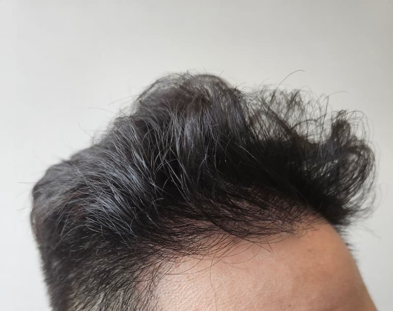 作者发布的术后1年发际线照片
