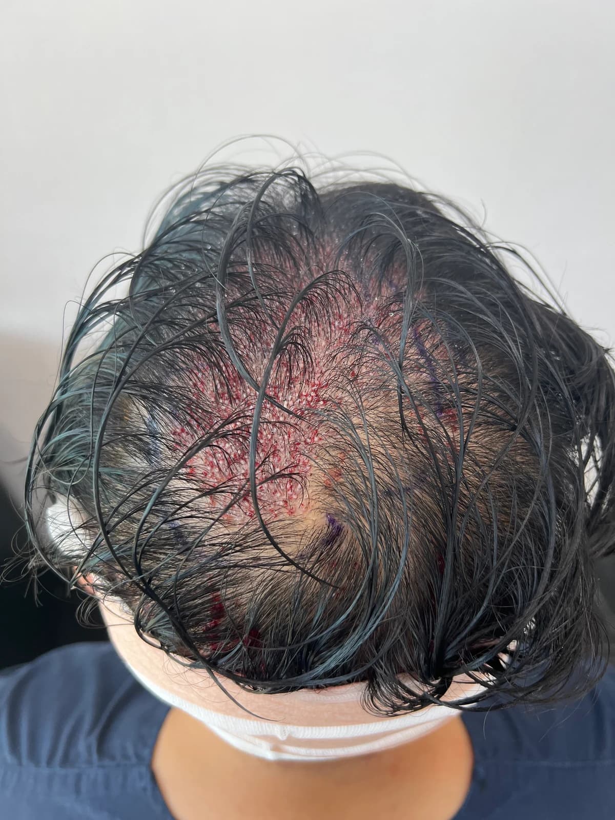 Immediately After Surgery · Crown Transplant Area