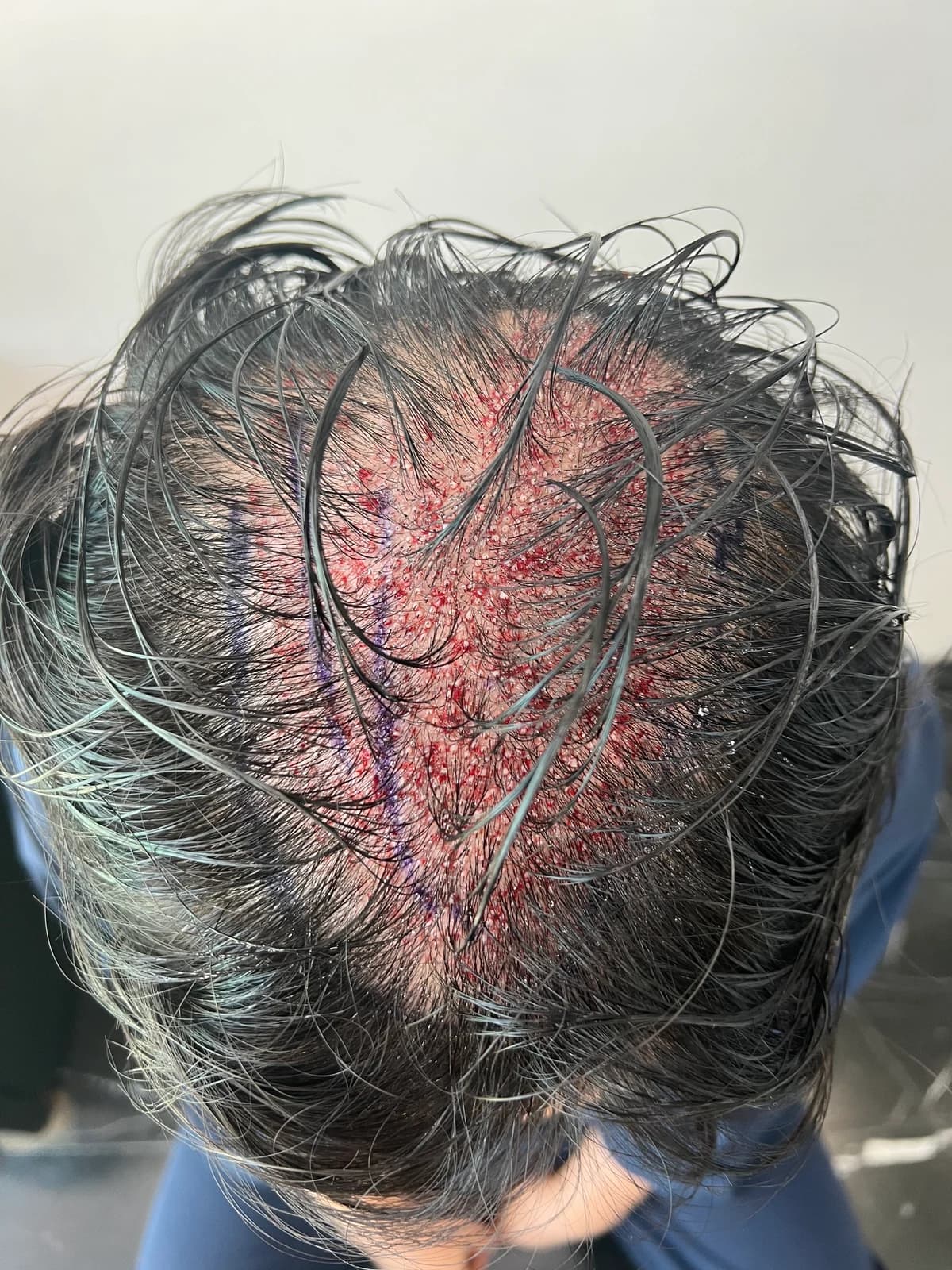 Immediately After Surgery · Top View of the Transplant Area