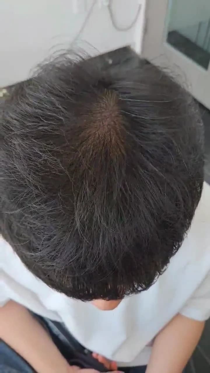 1 Year After Surgery · Still from the Crown Follow-Up Video