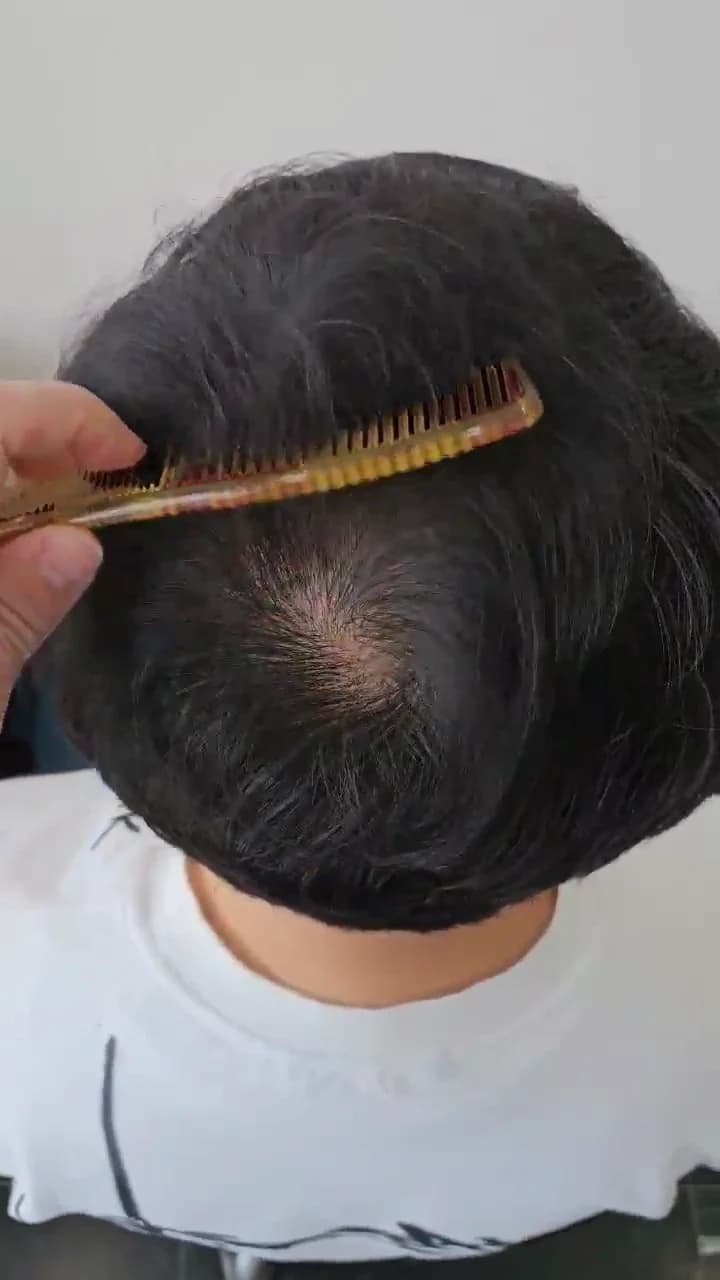 1 Year After Surgery · Crown with Hair Parted by a Comb, Video Still