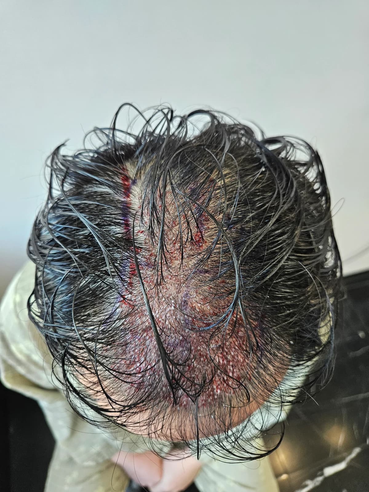 Immediately After Surgery · Midscalp Transplant Area