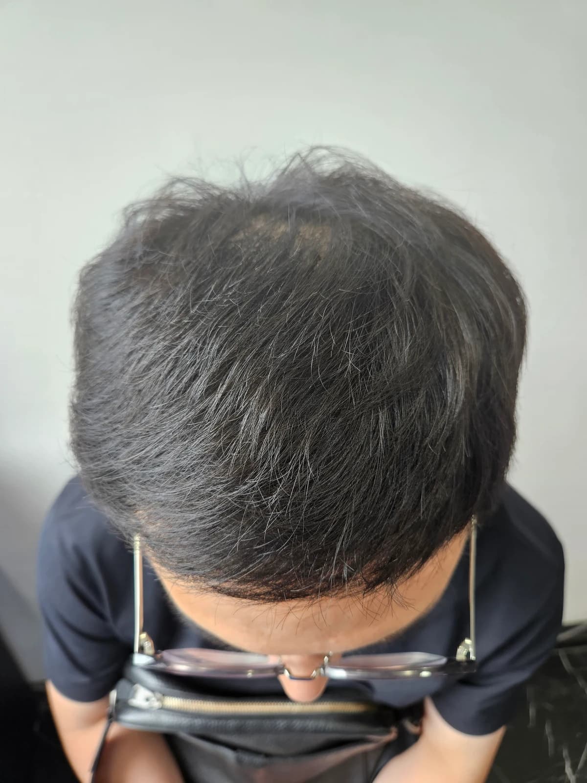 1 Year After Surgery · Midscalp Follow-Up