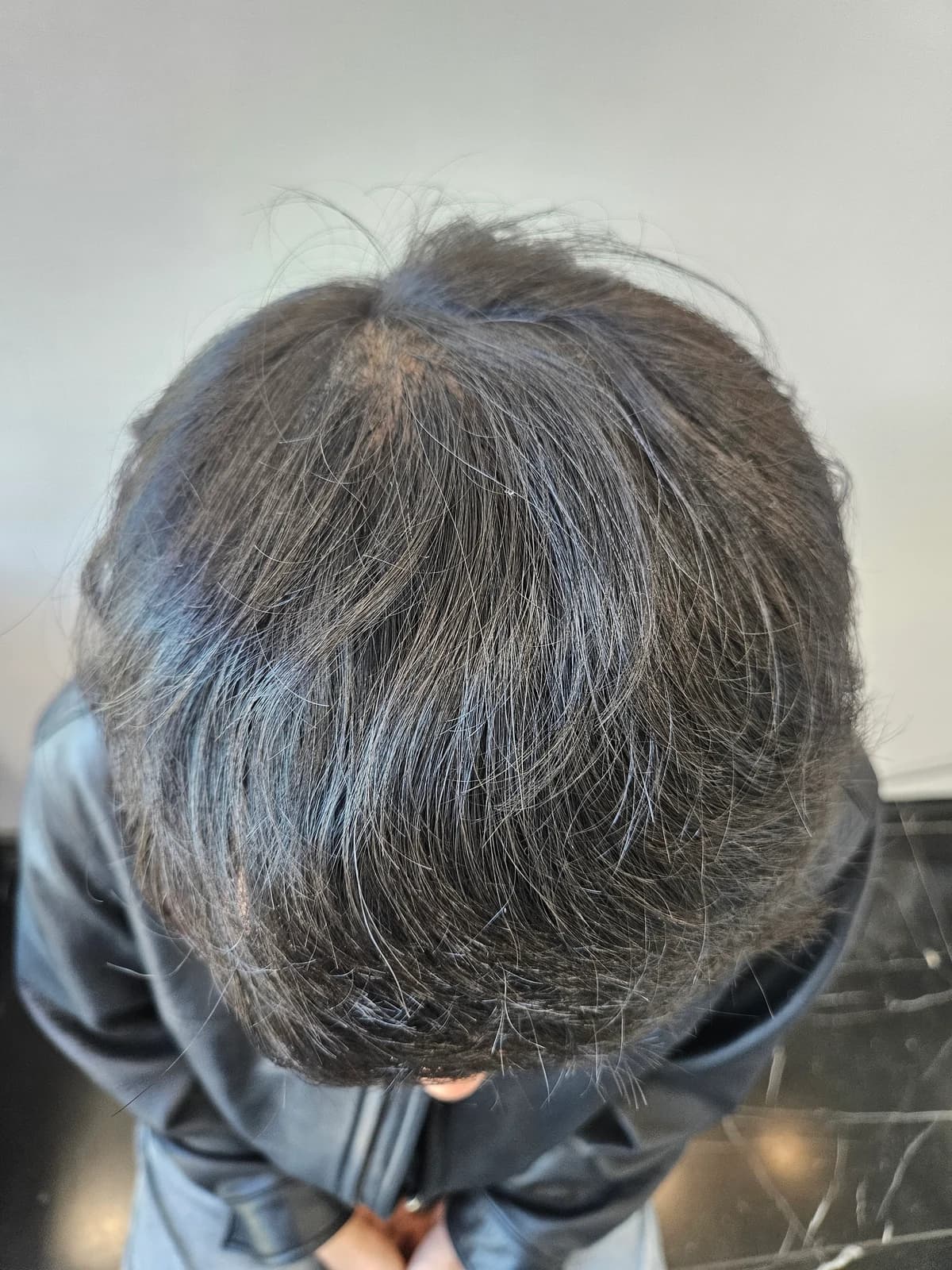 1 Year After Surgery · Top View of the Scalp