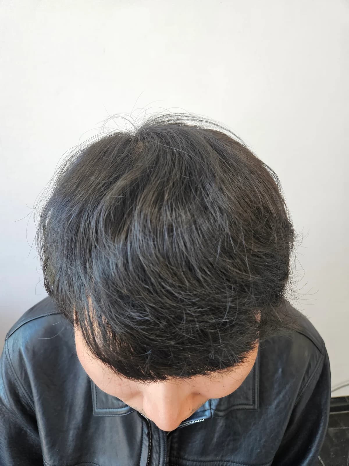1 Year After Surgery · Frontal Hair and Midscalp