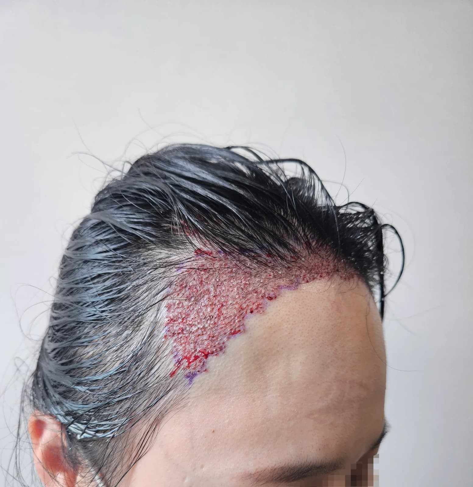 Immediately After Surgery · Right Hairline