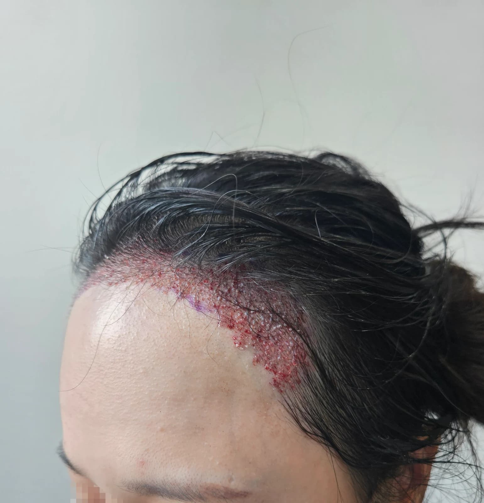 Immediately After Surgery · Left Hairline
