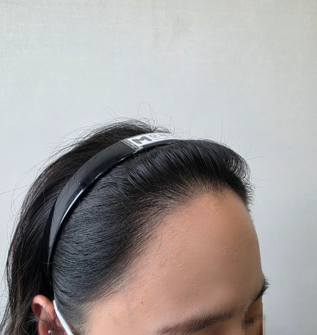 1 Year After Surgery · Right Hairline