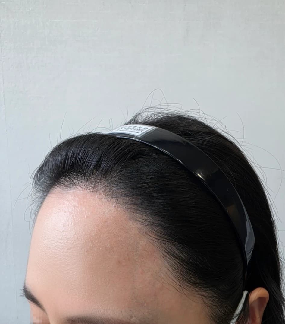 1 Year After Surgery · Left Hairline