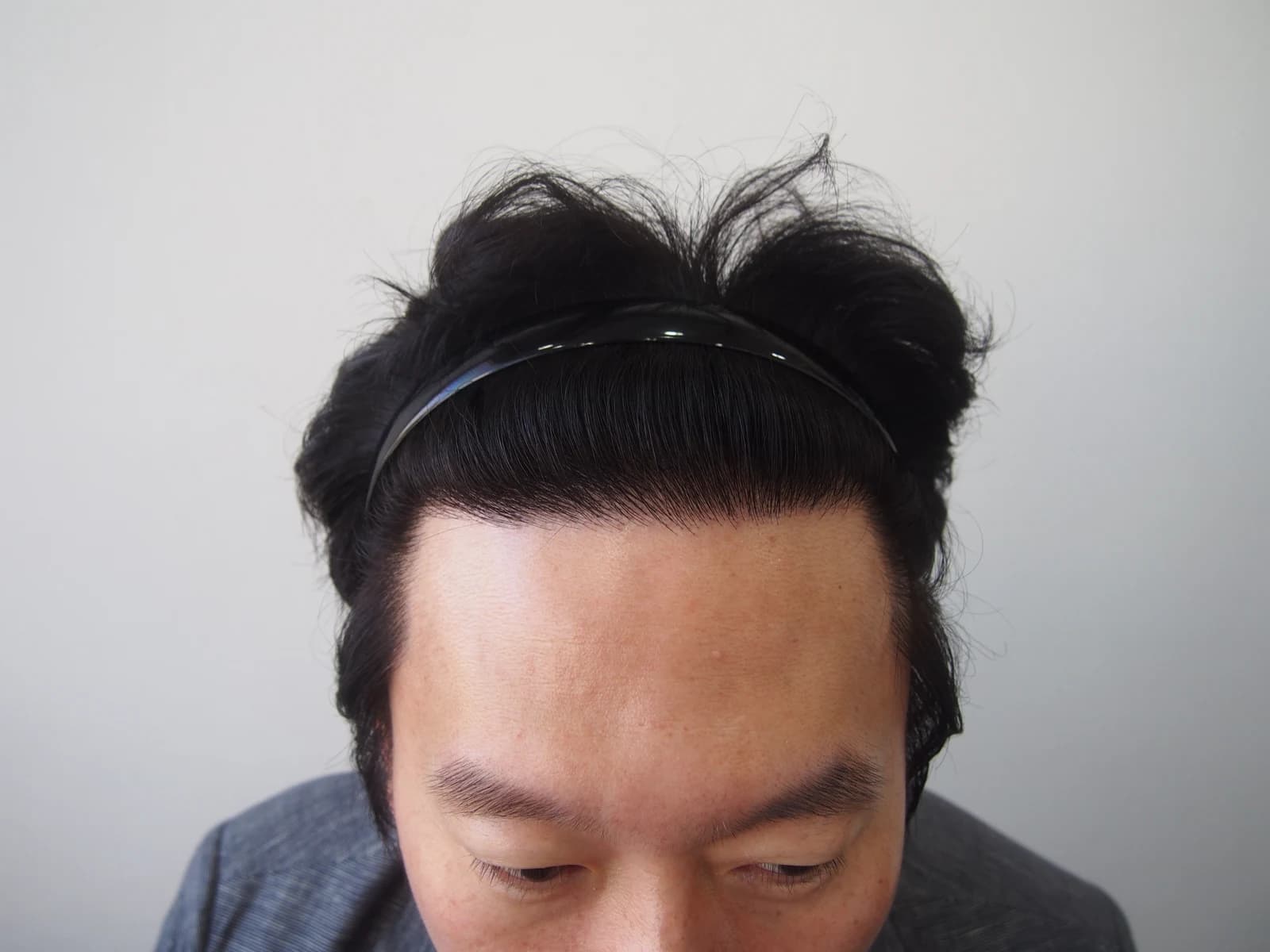 수술 후 사진