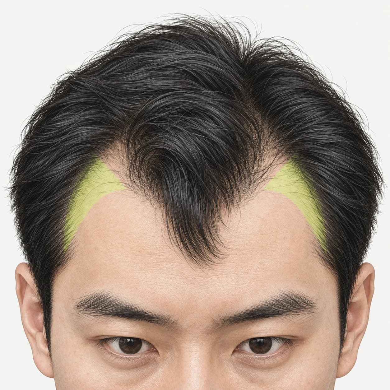 양쪽 이마의 M자 후퇴 범위를 표시한 교육용 그림