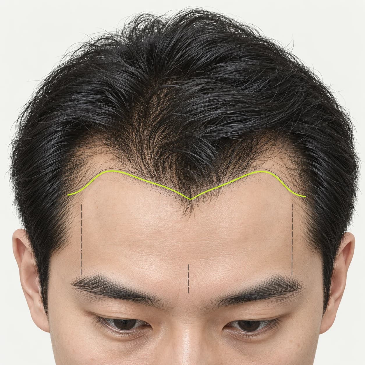 얼굴 비율과 관자부 연결을 고려한 이마선 디자인 교육용 그림
