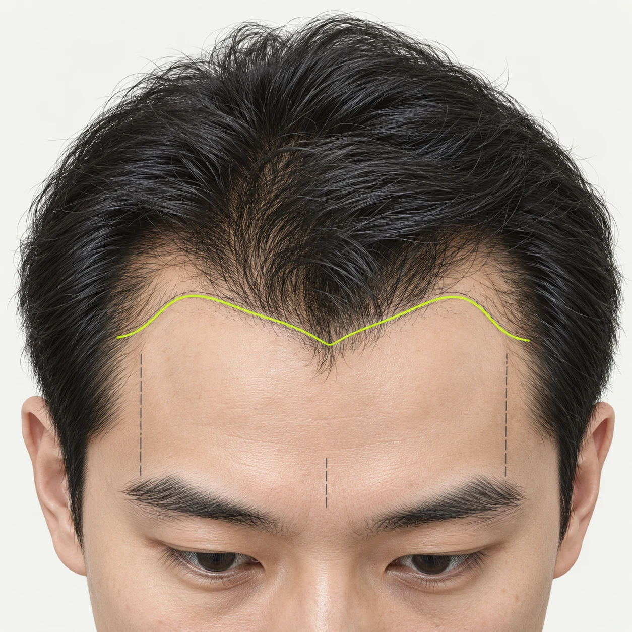 Educational illustration of hairline design considering facial proportions and temple transitions