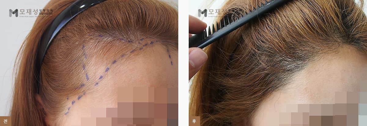 여성 헤어라인 교정 수술 전 디자인과 수술 후 모습