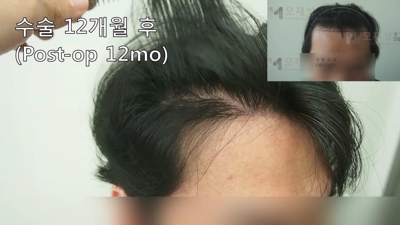 FUE Hair transplantation by Dr. Moh 영상 미리보기 배경