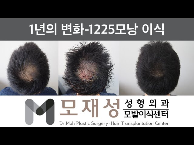 모재성의 탈모탈출! 비절개 정수리 교정 1년 비포&애프터 - 1225모낭 이식 영상 미리보기 배경