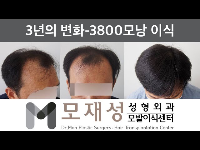 모재성의 탈모탈출! 비절개 정수리 및 전두부 광범위 교정 3년 비포&애프터 - 3600모낭 이식 영상 미리보기 배경