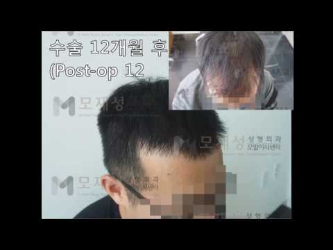 2차 FUE Hair transplantation by Dr. Moh 2ndary case. 영상 미리보기 배경
