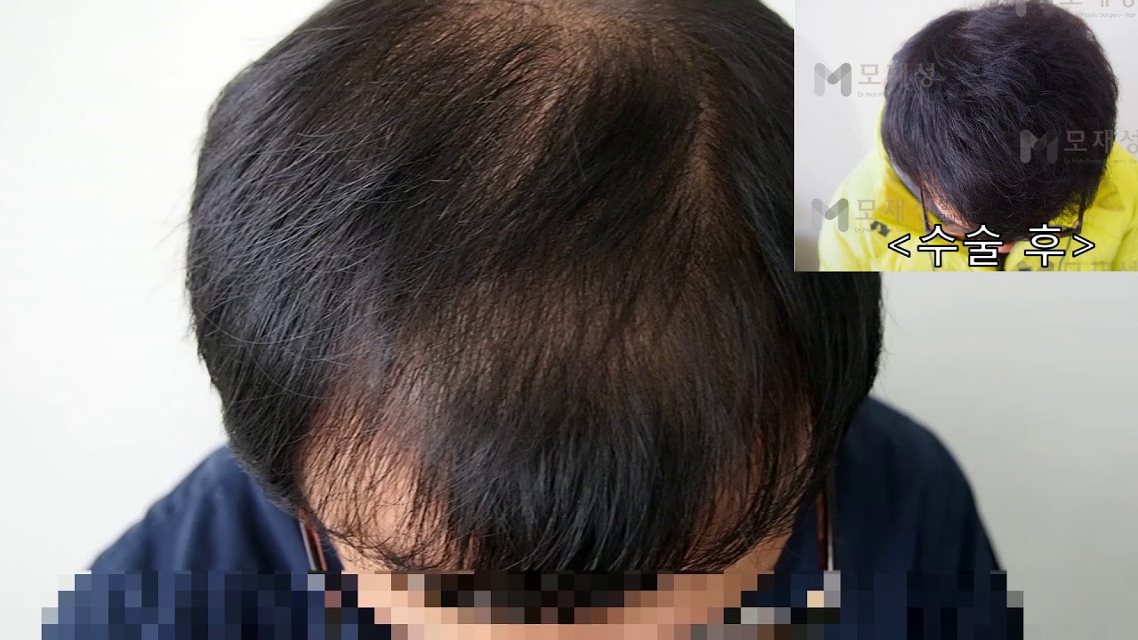 2차 FUE Hair transplantation by Dr. Moh 영상 미리보기 배경