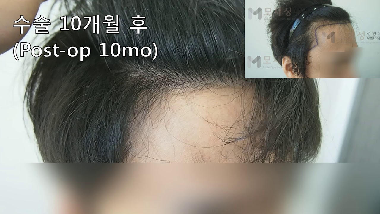 FUE Hair transplantation by Dr. Moh 영상 미리보기 배경