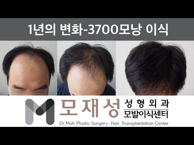 모재성의 탈모탈출! 비절개 정수리 및 전두부 광범위 교정 1년 비포&애프터 - 3700모낭 이식 영상 미리보기 배경