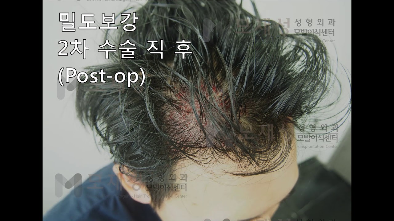 2차 FUE Hair transplantation by Dr. Moh 2ndary case. 영상 미리보기 배경
