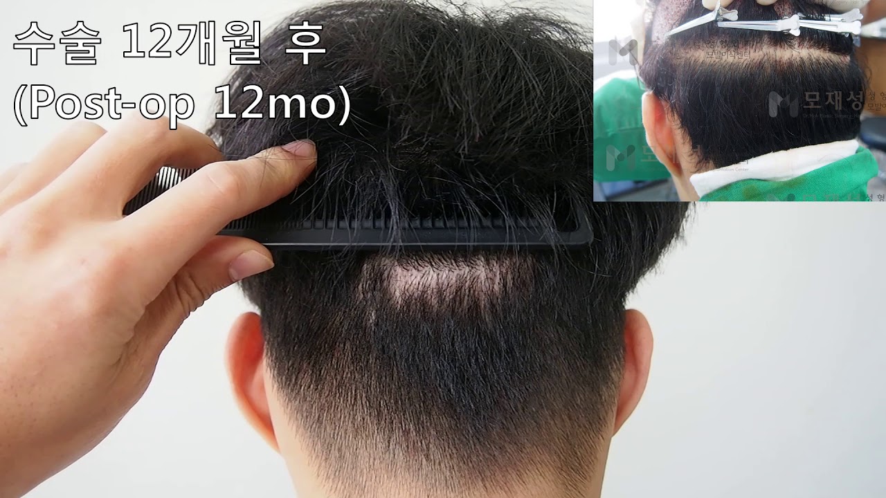 FUE Hair transplantation on scalp scar 영상 미리보기 배경