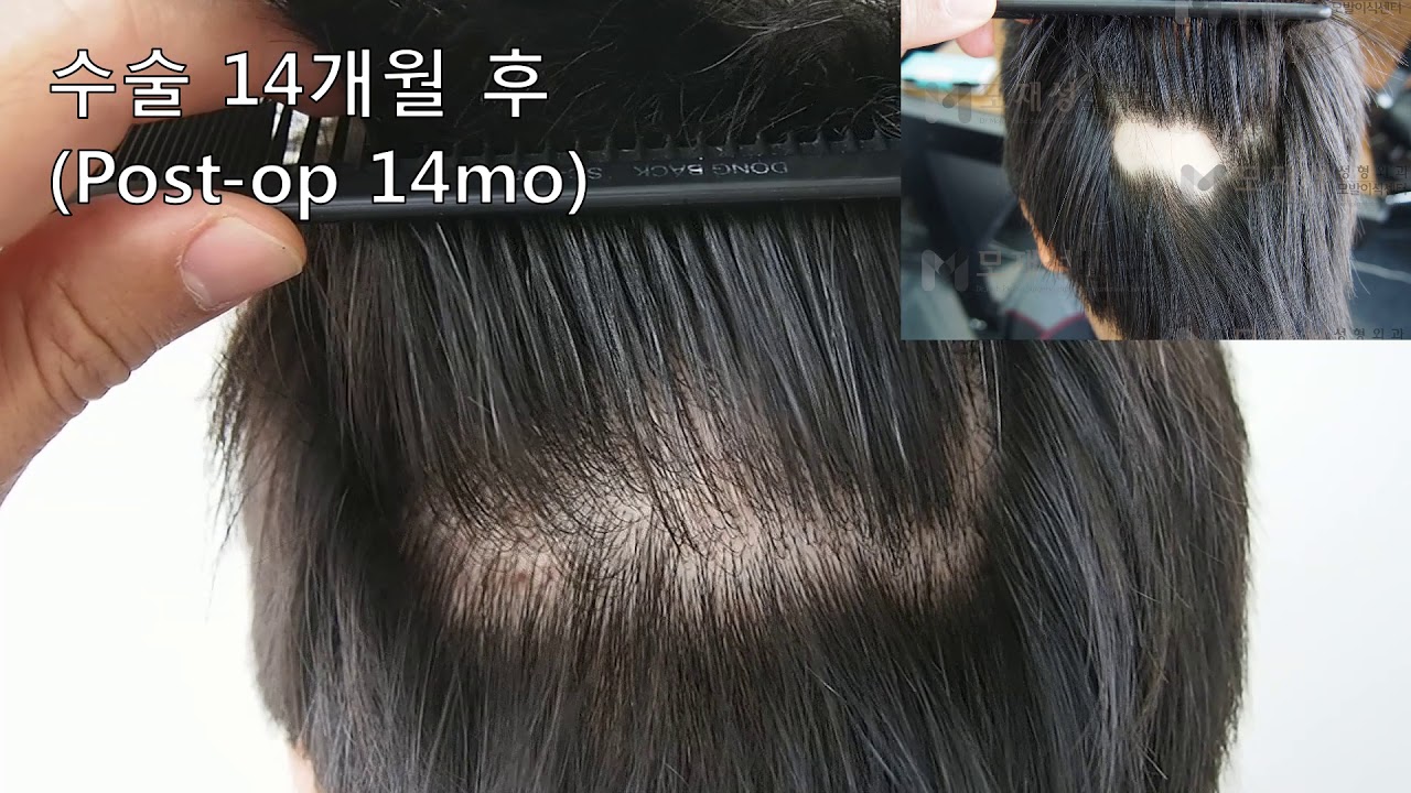 FUE Hair transplantation on scalp scar 영상 미리보기 배경