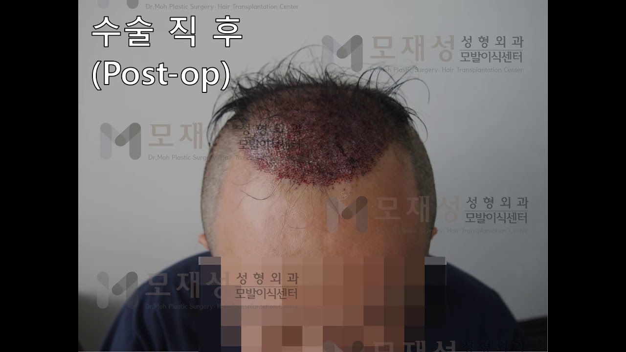 FUE Hair transplantation by Dr. Moh 2541graft(5598 hairs) 영상 미리보기 배경