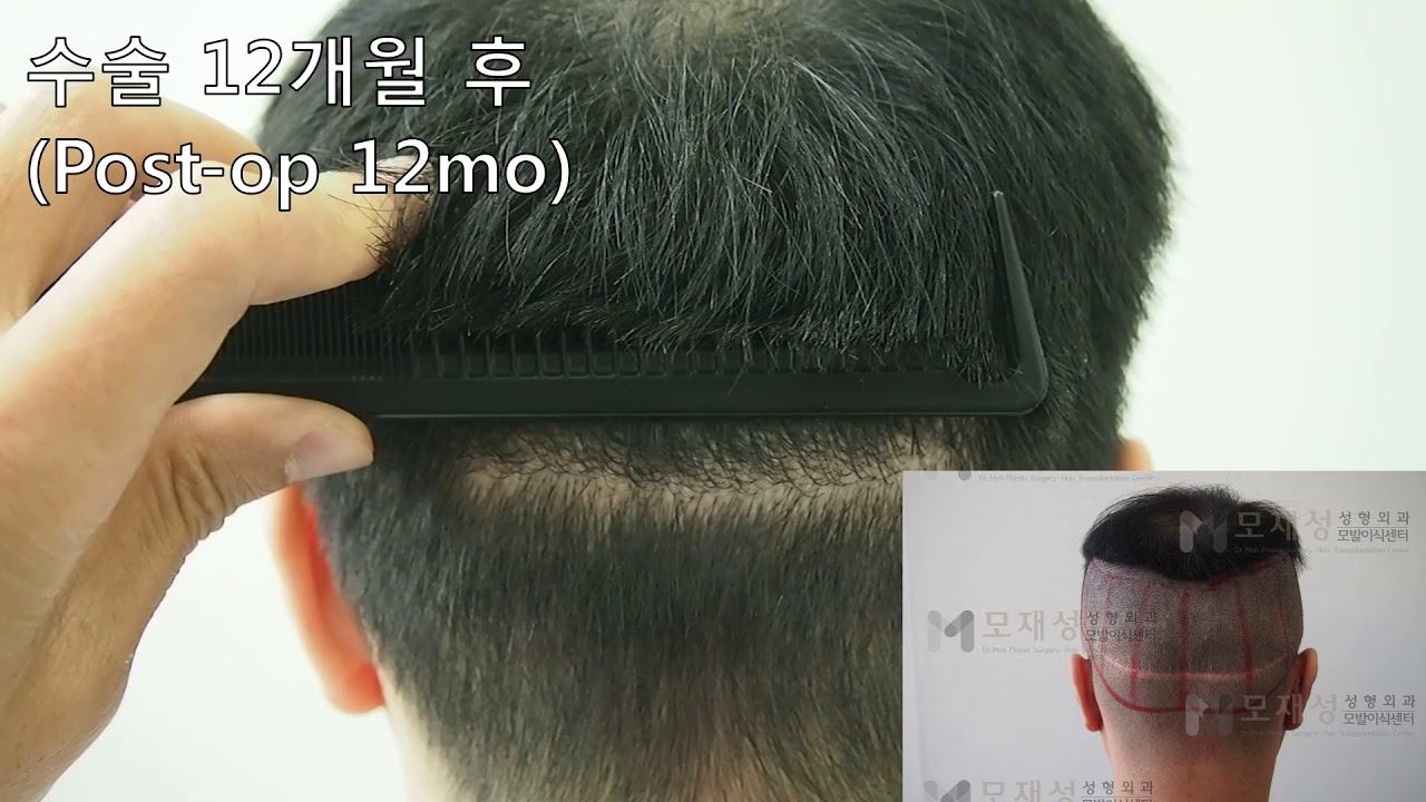 FUE Hair transplantation on scalp scar 영상 미리보기 배경