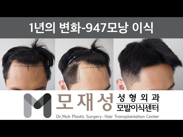 모재성의 탈모탈출! 비절개 초기 M자 탈모 1년 비포&애프터 - 947모낭 이식 영상 미리보기 배경