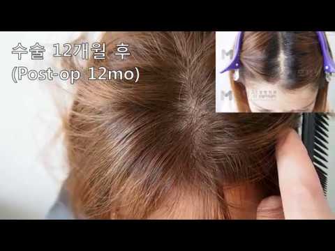 FUE Hair transplantation on scalp scar 영상 미리보기 배경