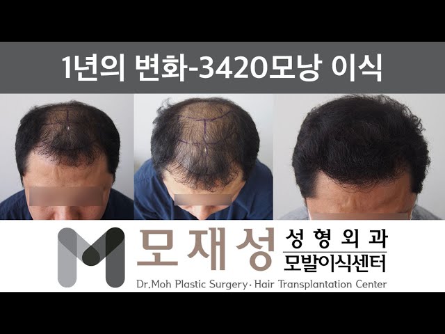 모재성의 탈모탈출! 비절개 전반적 탈모 광범위 교정 1년 비포&애프터 - 3420모낭 이식 영상 미리보기 배경