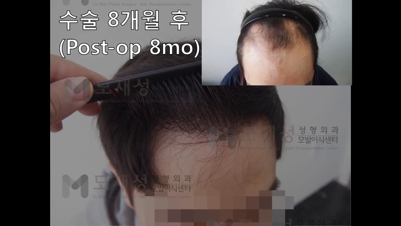 FUE Hair transplantation by Dr. Moh 영상 미리보기 배경