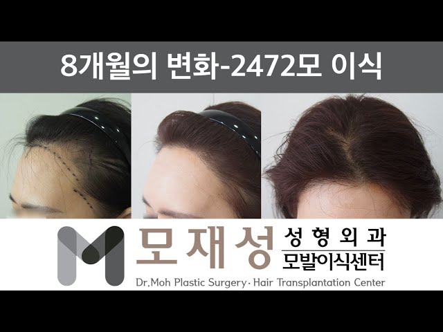 모재성의 탈모탈출! 여성 헤어라인 & 정수리 비절개+절개 8개월 비포 & 애프터 (헤어라인 2472모, 정수리 1000모 이식) 영상 미리보기 배경