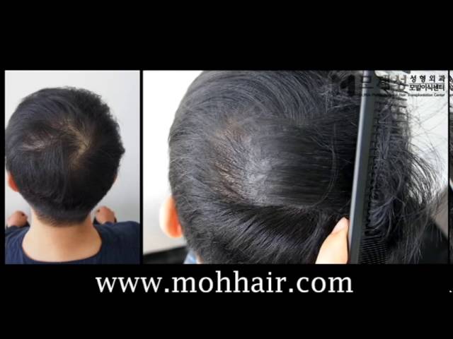 두피문신 시술전후 동영상 (scalp micropigmentation treatment) 영상 미리보기 배경