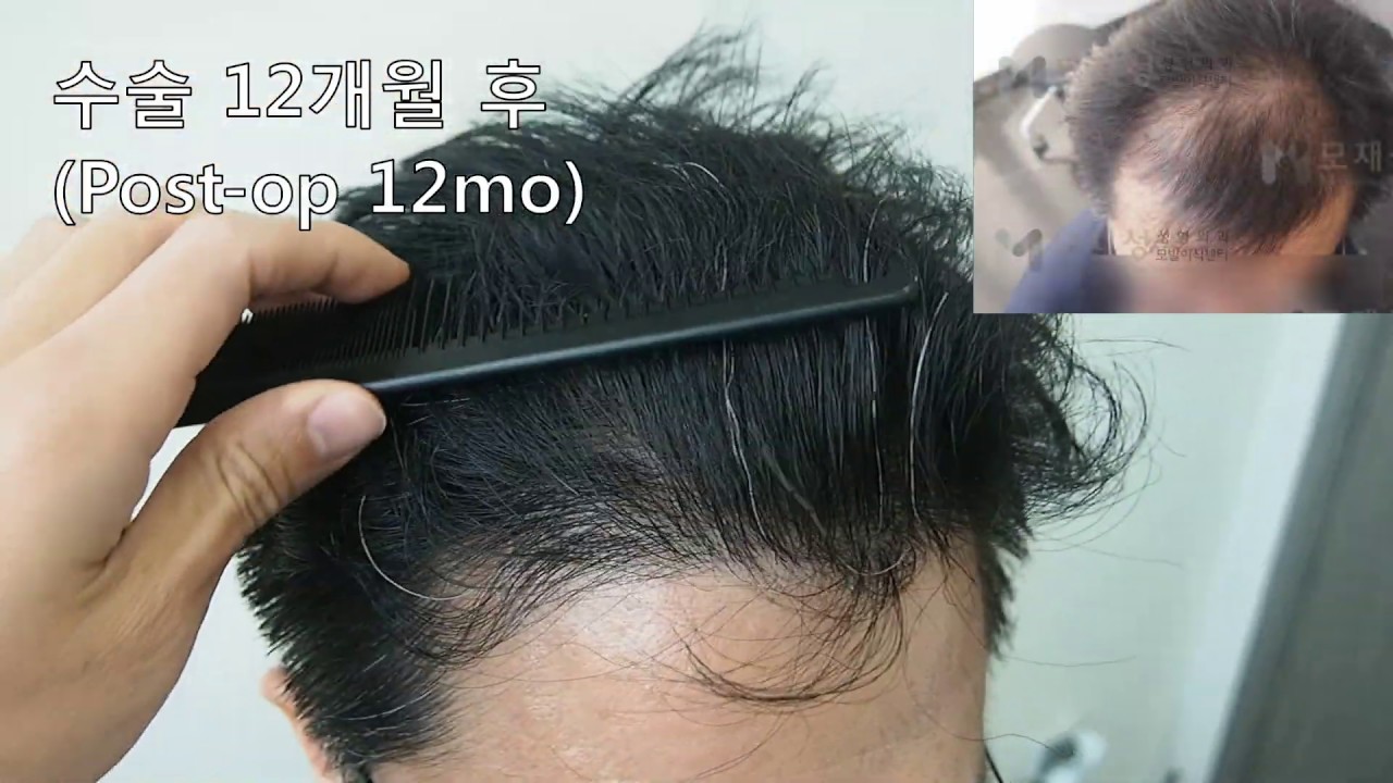 FUE Hair transplantation by Dr. Moh 영상 미리보기 배경
