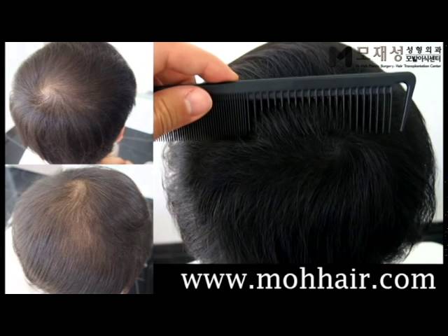두피문신(두피색소요법, scalp micropigmentation) 시술전후 영상 미리보기 배경