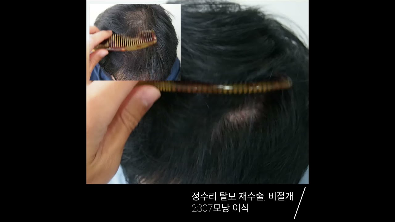 모재성의 탈모탈출! 밀도 보강을 위한 재수술 1년의 결과, 어떻게 변했을까요? 영상 미리보기 배경
