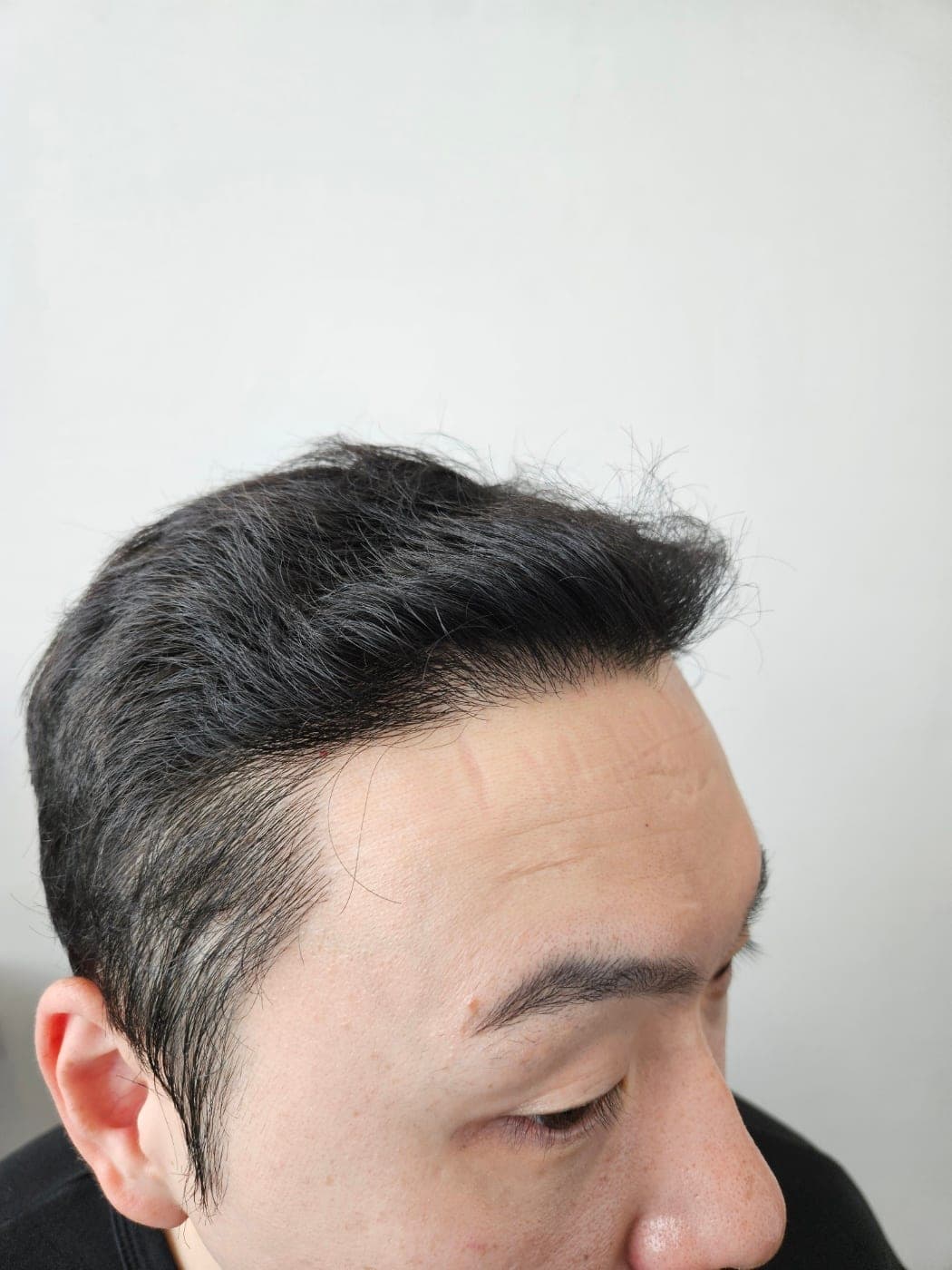 作者发布的术后照片