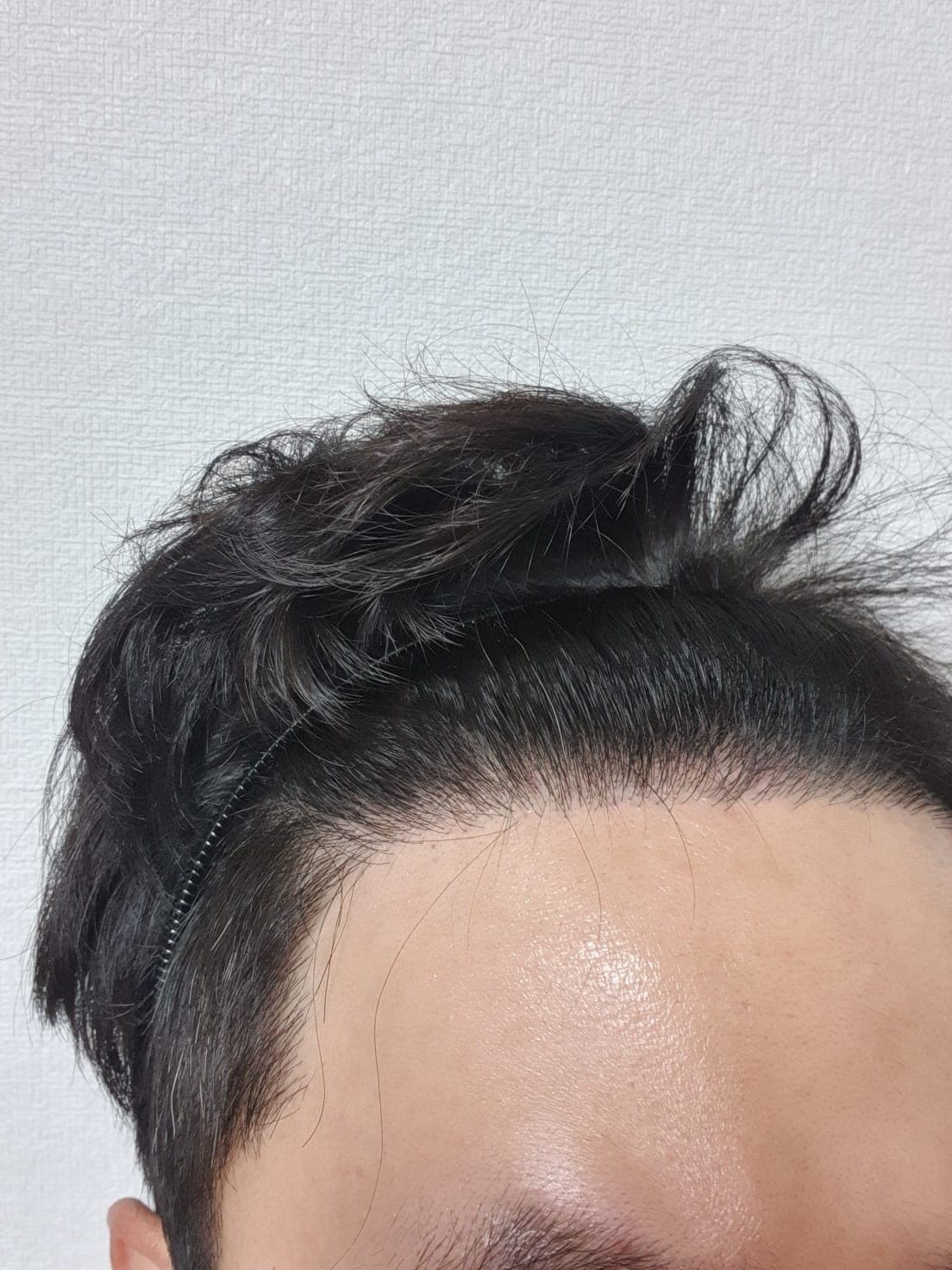 작성자가 게시한 수술 후 사진