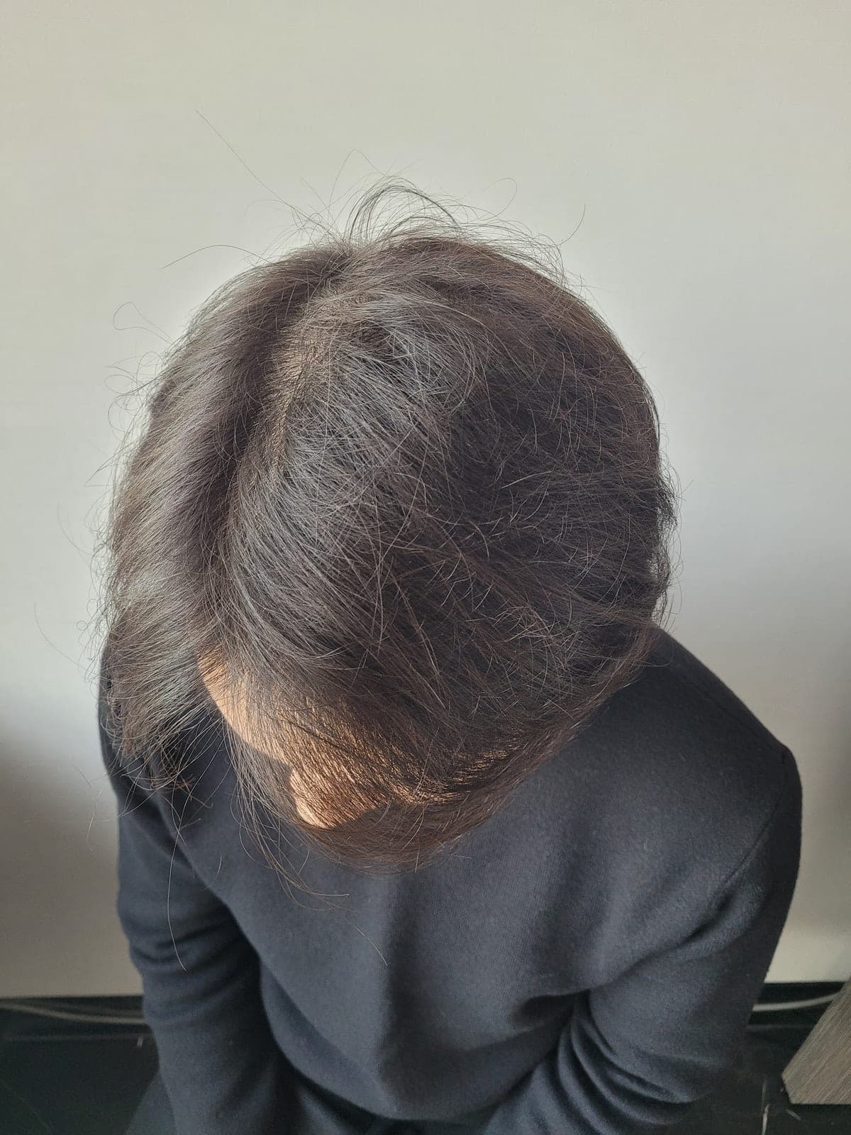 작성자가 게시한 수술 후 사진