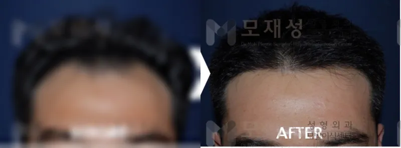 남성탈모 1,400모낭 수술 후 12개월 경과 가려진 수술 전 사진과 수술 후 사진
