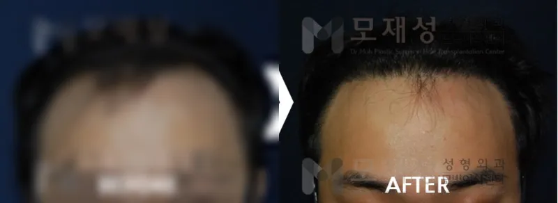 남성탈모 1,540모낭 수술 후 12개월 경과 가려진 수술 전 사진과 수술 후 사진