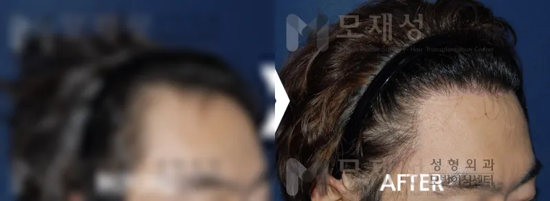 남성탈모 1,650모낭 수술 후 12개월 경과 가려진 수술 전 사진과 수술 후 사진