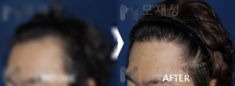 남성탈모 1,650모낭 수술 후 12개월 경과 가려진 수술 전 사진과 수술 후 사진